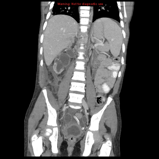 File:Appendicitis with phlegmon (Radiopaedia 9358-10046 B 44).jpg