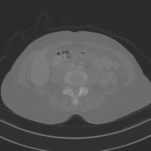 April fools' 2019- calcified peritoneal arachnoidosis (Radiopaedia 67273-76636 Axial bone window 26).png