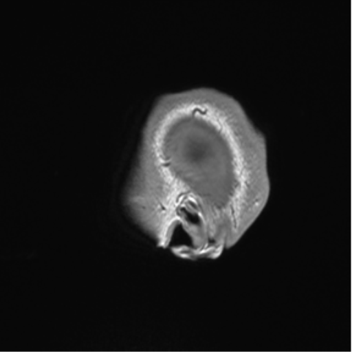 Arachnoid cyst with subdural hematoma (Radiopaedia 85892-101743 Sagittal T1 89).png