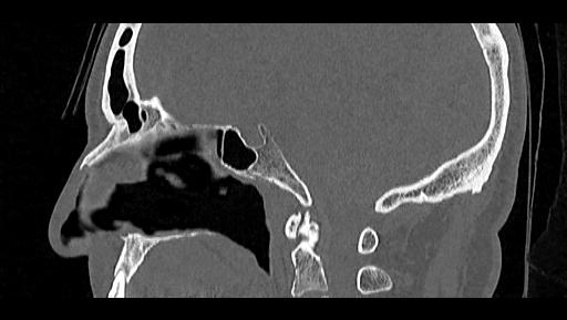 Arcuate foramen (Radiopaedia 89833-106944 Sagittal bone window 50).jpg