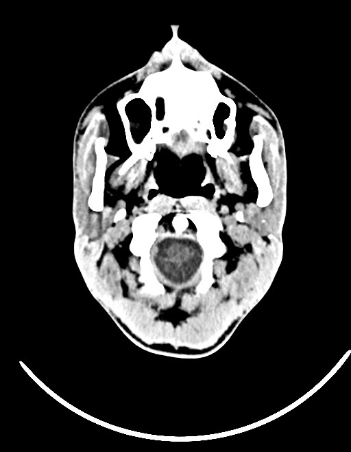 Arrow injury to the brain (Radiopaedia 72101-82607 Axial non-contrast 48).jpg