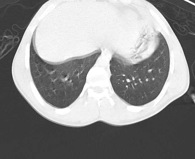 Arrow injury to the chest (Radiopaedia 75223-86321 Axial lung window 78).jpg