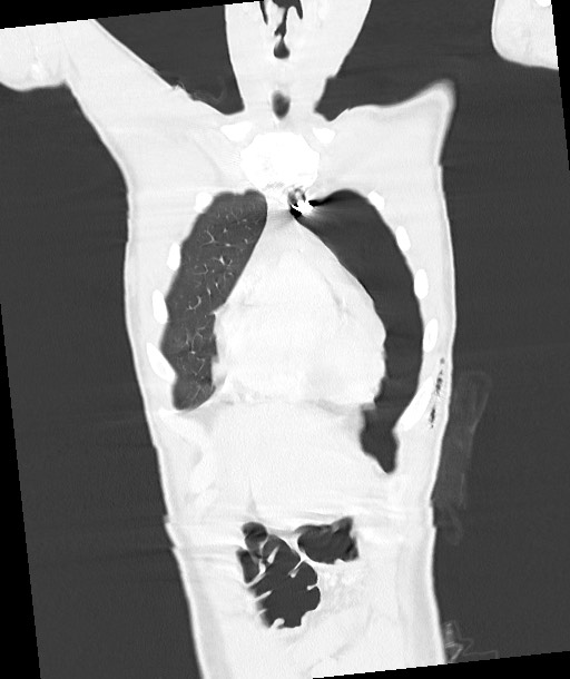 Arrow injury to the chest (Radiopaedia 85367-100975 Coronal lung window 47).jpg