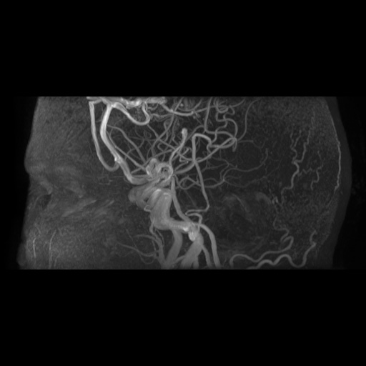 Arteriovenous malformation (Radiopaedia 71628-81999 Axial MRA 3).jpg