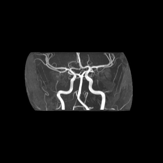 Artery of Percheron infarct (Radiopaedia 40966-43676 F 1).jpg