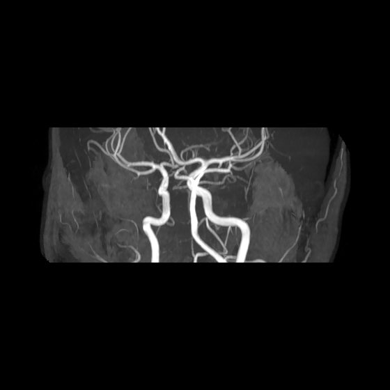 File:Artery of Percheron infarct (Radiopaedia 40966-43676 G 38).jpg