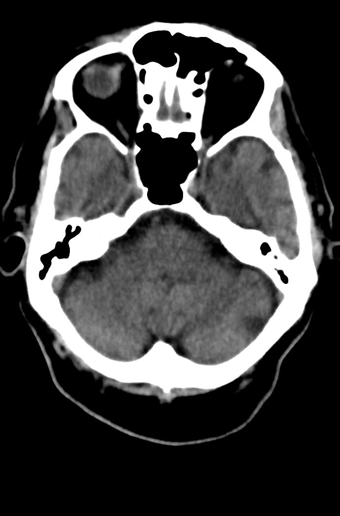 Artery of Percheron infarction (Radiopaedia 80613-94202 Axial non-contrast 55).jpg