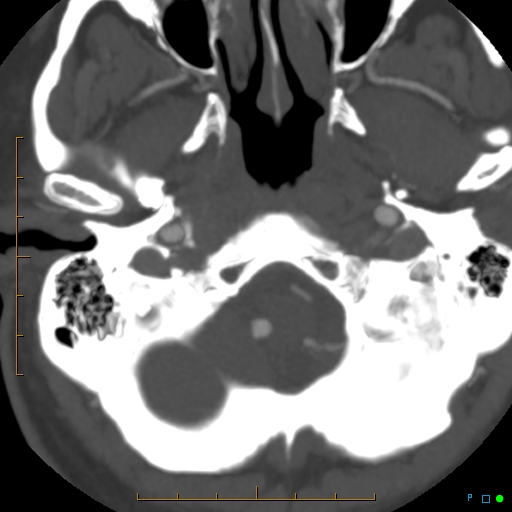 File:Artifactual basilar artery stenosis due to metallic stent (Radiopaedia 31206-31923 A 5).jpg