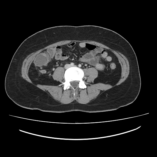 Ascending retrocecal appendicitis with liver abscesses (Radiopaedia 60066-67615 B 57).jpg