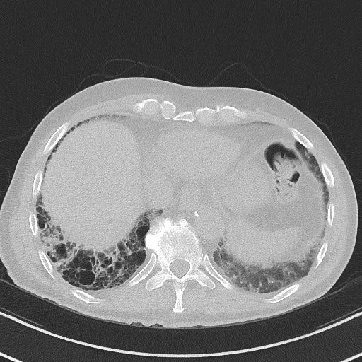 Aspergilloma on background pulmonary fibrosis (Radiopaedia 60942-68757 A 45).jpg