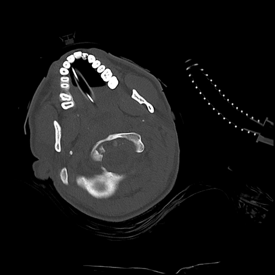 Atlanto-occipital dissociation (Traynelis type 1), C2 teardrop fracture, C6-7 facet joint dislocation (Radiopaedia 87655-104061 Axial bone window 17).jpg