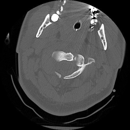 Atlanto-occipital dissociation injury (Radiopaedia 29274-29698 Axial bone window 18).png