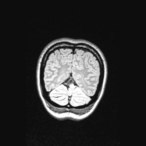 Atretic encephalocoele with inferior vermis hypoplasia (Radiopaedia 30443-31108 Coronal FLAIR 34).jpg