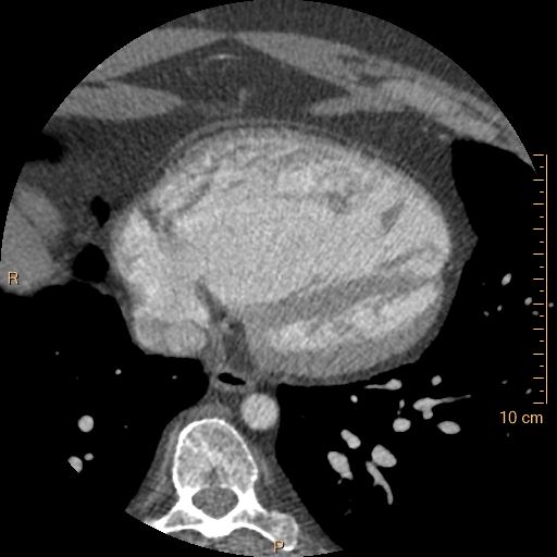 Atrial septal defect (upper sinus venosus type) with partial anomalous pulmonary venous return into superior vena cava (Radiopaedia 73228-83961 A 209).jpg