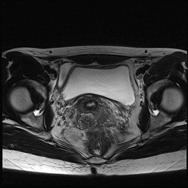 File:Atypical deep infiltrating endometriosis (Radiopaedia 44470-48125 Axial T2 20).jpg