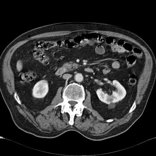 Atypical hepatocellular carcinoma (Radiopaedia 41744-44698 B 49).jpg
