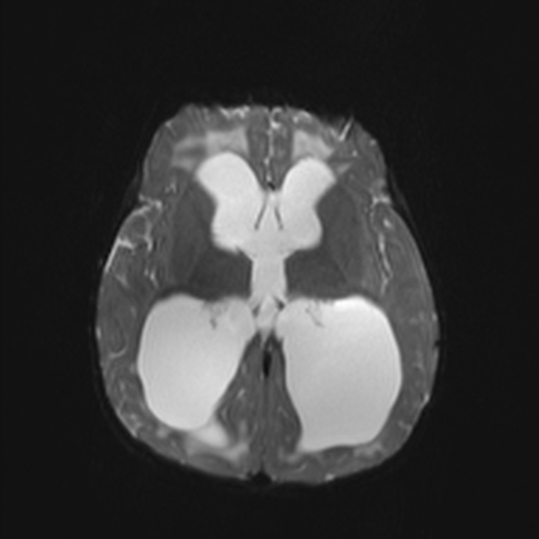 Atypical medulloblastoma (Radiopaedia 34903-36371 Axial DWI 16).jpg