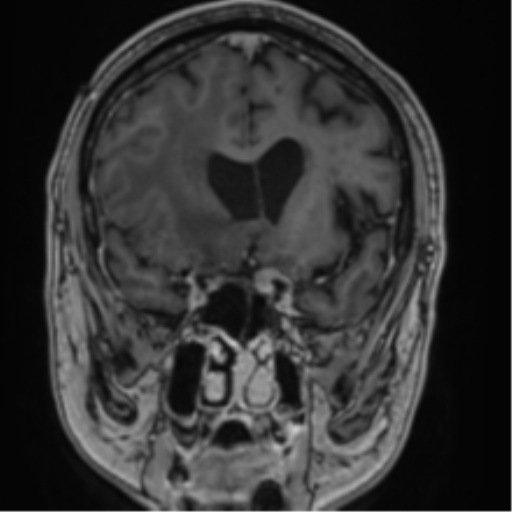 Atypical meningioma (WHO grade II) with brain invasion (Radiopaedia 57767-64729 Coronal T1 C+ 30).png