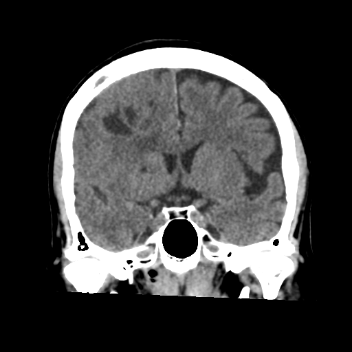 Atypical meningioma (WHO grade II) with osseous invasion (Radiopaedia 53654-59715 Coronal non-contrast 29).png