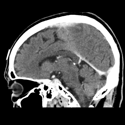 Atypical meningioma (WHO grade II) with osseous invasion (Radiopaedia 53654-59715 G 30).png