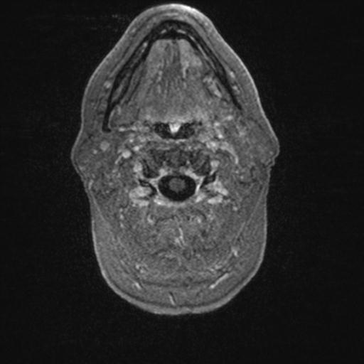 Atypical meningioma (grade II) - en plaque (Radiopaedia 29633-30147 Axial T1 C+ 11).jpg