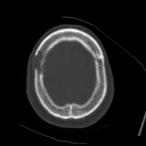 Atypical meningioma with skull invasion (Radiopaedia 34357-35649 Axial bone window 70).png