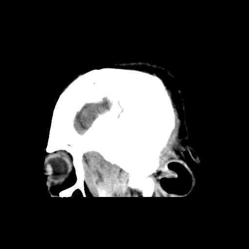 File:Atypical meningioma with skull invasion (Radiopaedia 34357-35649 E 7).png