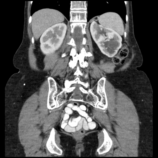File:Atypical renal cyst (Radiopaedia 17536-17251 C 9).jpg