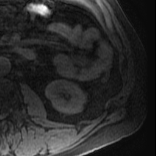 File:Atypical renal cyst on MRI (Radiopaedia 17349-17046 Axial T1 fat sat 25).jpg