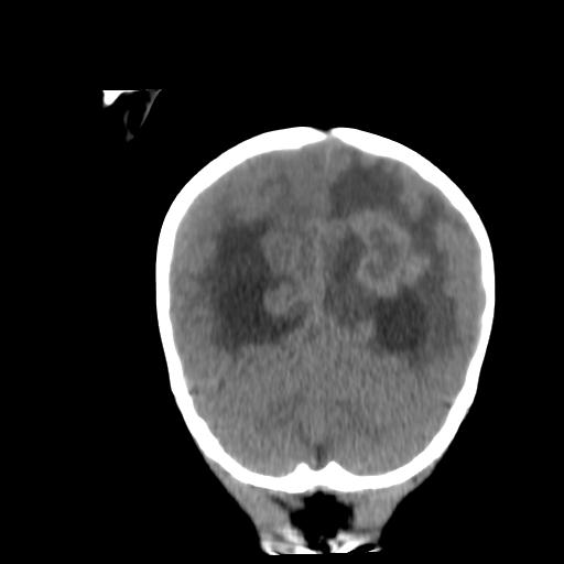 Atypical teratoid rhabdoid tumor (AT-RT) (Radiopaedia 85823-101654 Coronal non-contrast 42).jpg