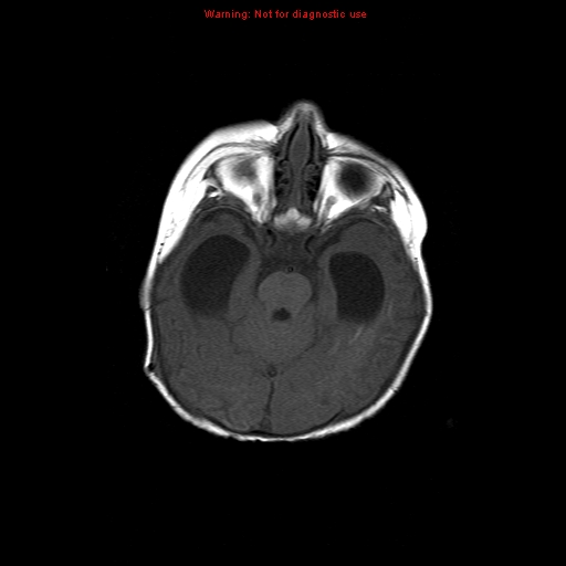 File:Atypical teratoid rhabdoid tumor (Radiopaedia 10712-11183 Axial T1 12).jpg