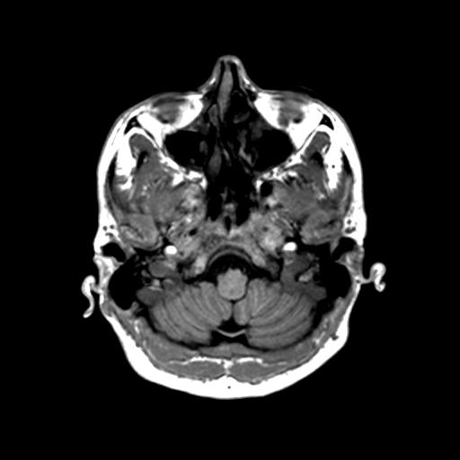 Autoimmune limbic encephalitis (Radiopaedia 30363-31005 T1 Axial 1mm 28).jpg