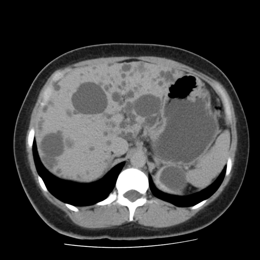 Autosomal dominant polycystic kidney disease (Radiopaedia 23061-23093 C+ delayed 17).jpg