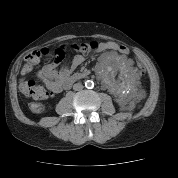 Autosomal dominant polycystic kidney disease (Radiopaedia 27851-28094 Axial non-contrast 78).jpg