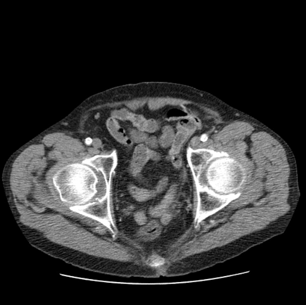 Autosomal dominant polycystic kidney disease (Radiopaedia 27851-28094 B 114).jpg