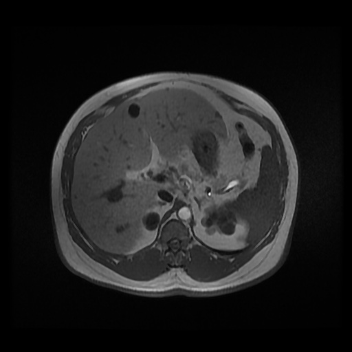 Autosomal dominant polycystic kidney disease (Radiopaedia 50259-55611 Axial 2D Dual Echo 32).jpg