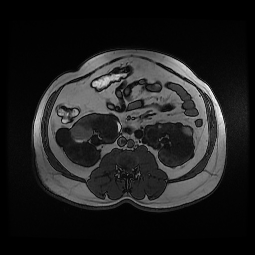 Autosomal dominant polycystic kidney disease (Radiopaedia 50259-55611 Axial 2D Dual Echo 53).jpg