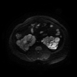 Autosomal dominant polycystic kidney disease (Radiopaedia 50259-55611 Axial DWI 64).jpg