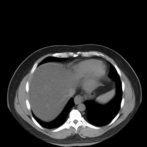 Autosomal dominant polycystic kidney disease (Radiopaedia 50259-55612 Axial non-contrast 14).jpg
