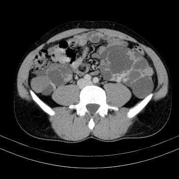 Autosomal dominant polycystic kidney disease (Radiopaedia 66349-75582 B 65).jpg
