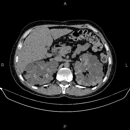 Autosomal dominant polycystic kidney disease (Radiopaedia 87830-104287 Axial non-contrast 19).jpg