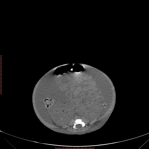 File:Autosomal recessive polycystic kidney disease associated with Caroli disease (Radiopaedia 61932-69984 B 252).jpg