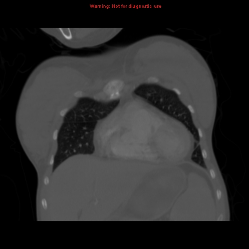 Avascular necrosis in sickle cell disease (Radiopaedia 17448-17152 Coronal bone window 29).jpg