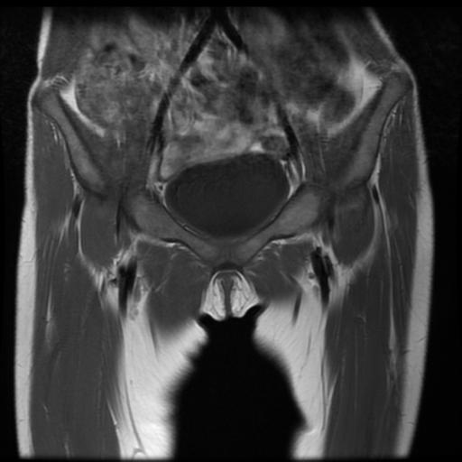 File:Avascular necrosis of the hip (Radiopaedia 29563-30067 Coronal T1 2).jpg