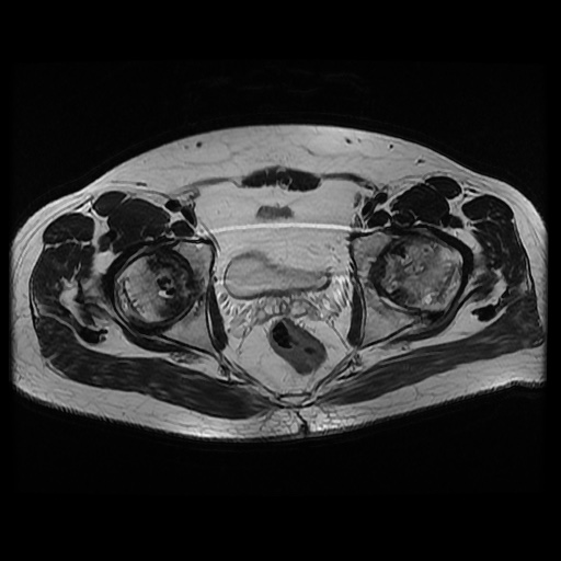 File:Avascular necrosis of the hip (Radiopaedia 61503-69465 T2 16).jpg