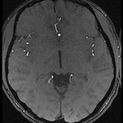 File:Azygos anterior cerebral artery (Radiopaedia 17059-16756 Axial MRA 22).jpg