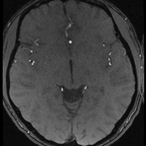 Azygos anterior cerebral artery (Radiopaedia 17059-16756 Axial MRA 24).jpg