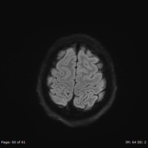 Balo concentric sclerosis (Radiopaedia 61637-69636 I 370).jpg