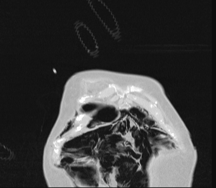 Barotrauma due to mechanical ventilation (Radiopaedia 28079-28336 Coronal lung window 9).jpg