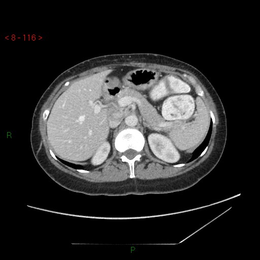 Bartholin gland cyst (Radiopaedia 54904-61181 A 29).jpg